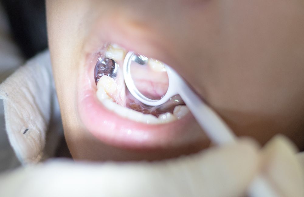 Amalgam (Silver) Fillings​