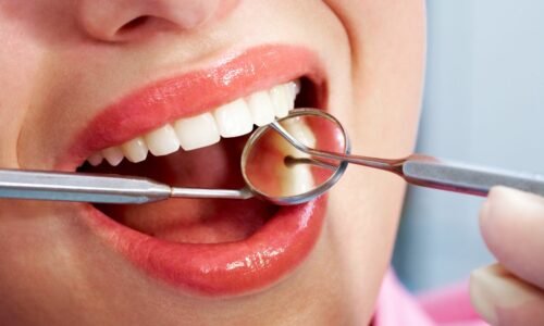 Smiles By Choice Dental Bonding