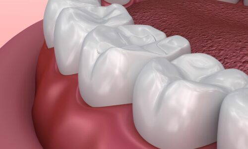Smiles By Choice Dental Fillings 2