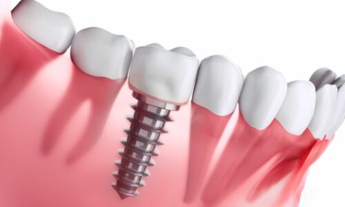 Smiles By Choice Dental Implants