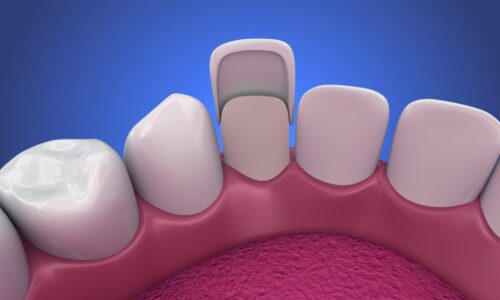 Smiles By Choice Dental Veneers