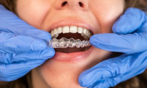smilesbychoice-Invisalign