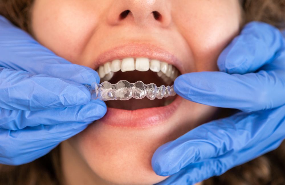 smilesbychoice-Invisalign